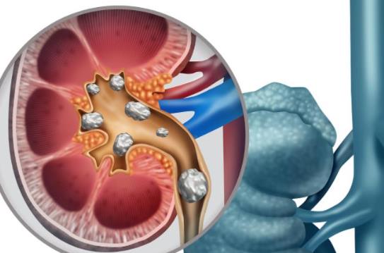 腎結(jié)石多大需要手術(shù) 腎結(jié)石會變成腎炎嗎