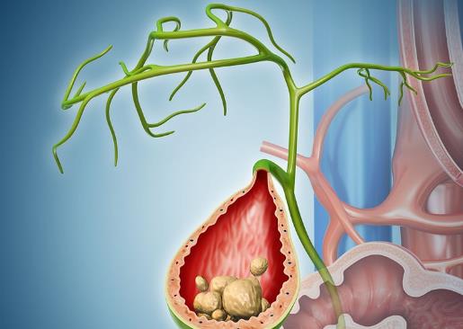 膽結(jié)石手術(shù)有風(fēng)險嗎 膽結(jié)石手術(shù)有哪些風(fēng)險