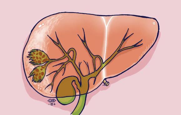 膽結(jié)石變小是好事嗎 膽結(jié)石會變小嗎