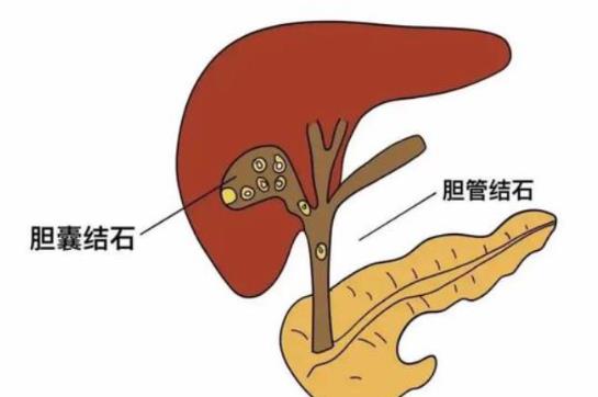 膽結(jié)石是哪里痛 膽結(jié)石痛怎么緩解