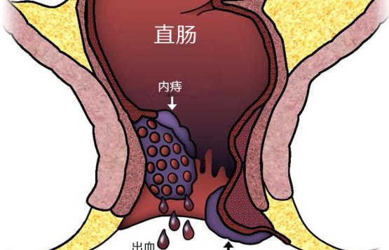 痔瘡出血怎么治療 痔瘡出血但不疼怎么回事