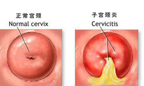 宮頸息肉是宮頸炎嗎 宮頸水泡是宮頸炎嗎