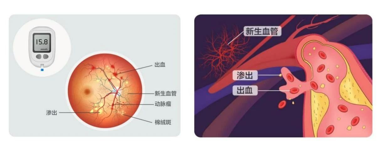 【合肥愛爾】得了糖尿病，為什么醫(yī)生讓我看眼科？