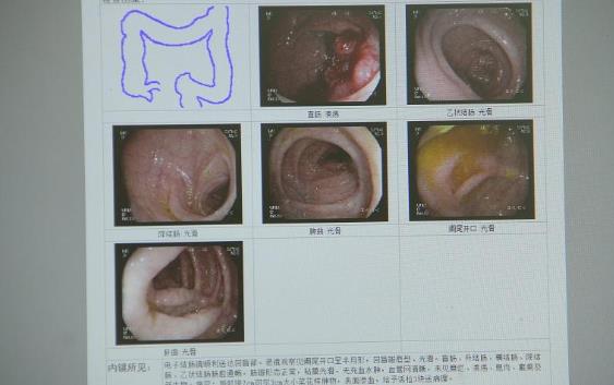 直腸癌會(huì)擴(kuò)散嗎 直腸癌擴(kuò)散快嗎