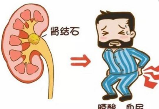 腎結石打針有用嗎 腎結石跑步有用嗎