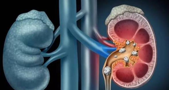 腎結(jié)石對身體有危害嗎 腎結(jié)石在輸尿管會回到腎里嗎