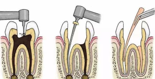 牙齒做根管治療貴嗎 二次根管治療費用比第一次貴嗎