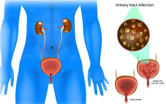 慢性膀胱炎無(wú)藥可治嗎 慢性膀胱炎注意什么
