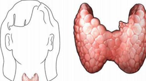 甲狀腺癌的發(fā)病率高嗎 甲狀腺癌的治愈率如何