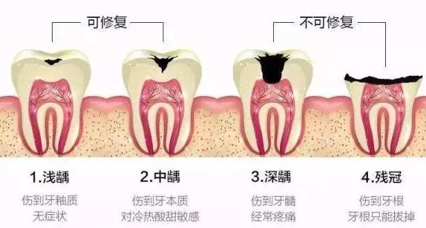 根管治療后牙齒痛正常嗎 根管治療后注意什么