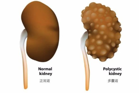 腎囊腫與多囊腎有哪些區(qū)別 多囊腎有哪些癥狀