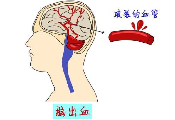 腦出血是什么原因?qū)е?不良生活習慣高血壓顱腦外傷