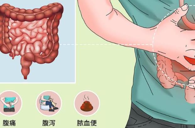 慢性結(jié)腸炎能治愈嗎 慢性結(jié)腸炎注意什么