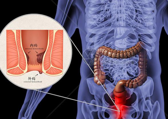 痔瘡會導致便秘嗎 痔瘡不痛不癢怎么回事