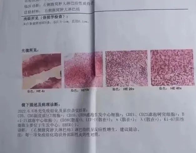 發(fā)熱原因不明，PET-CT診斷罕見成人斯蒂爾病